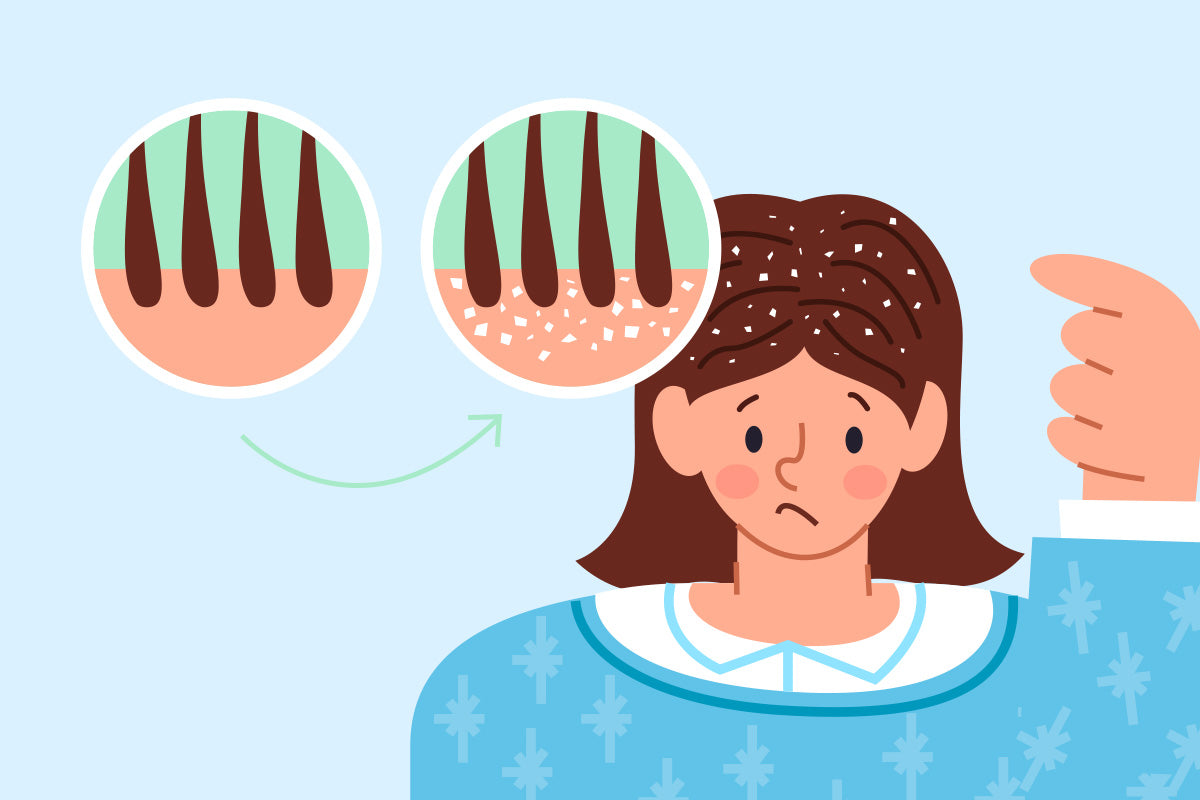 5 effective ways to prevent dandruff in Monsoon